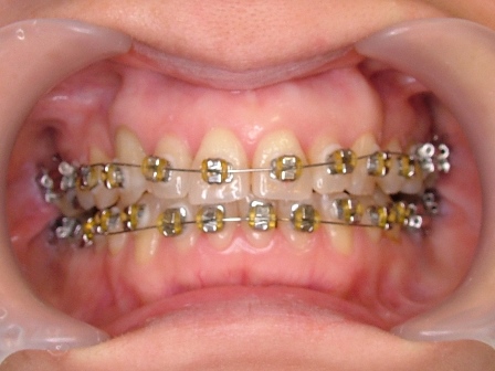 成人の歯周矯正治療