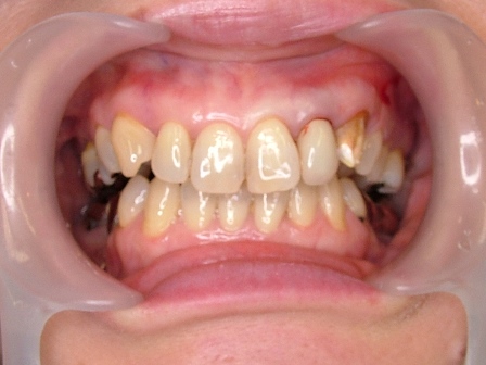 左上の前から３番目の歯