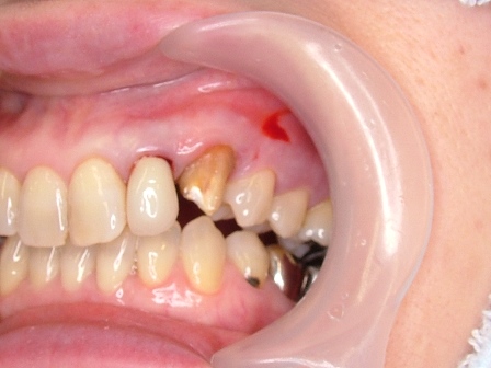 左上の前から３番目の歯
