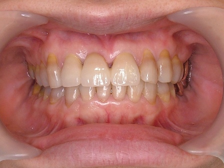 最終段階で、セラミックの歯が入った状態